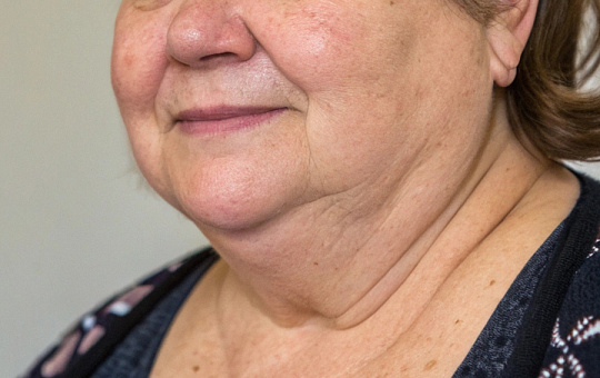 Найдена причинно-следственная связь между ожирением и старением кожи лица