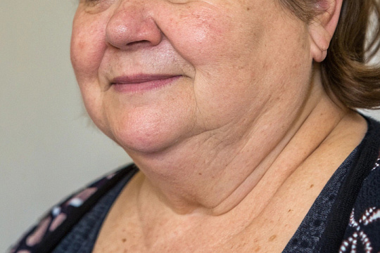 Найдена причинно-следственная связь между ожирением и старением кожи лица