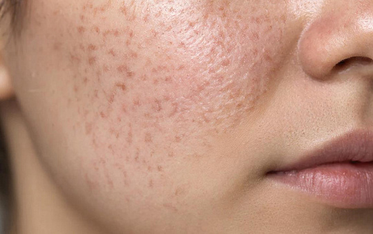 Фракционный CO2-лазер эффективнее микроигольчатого RF в терапии постакне