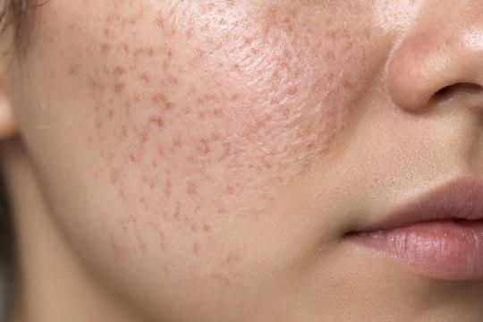 Фракционный CO2-лазер эффективнее микроигольчатого RF в терапии постакне