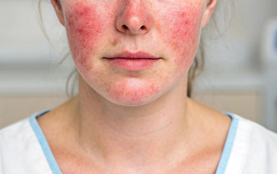 Розацеа связали с поражением сердечно-сосудистой системы