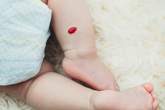 Комбинированный протокол коррекции изменений кожи, возникших вследствие лечения гемангиом в раннем детстве