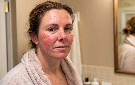 Тимолол не оправдал себя в лечении папулопустулозной розацеа