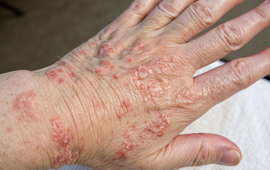 Американские врачи: пациенты с дерматозами страдают депрессией