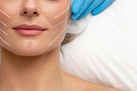 Легальное применение нитевого лифтинга