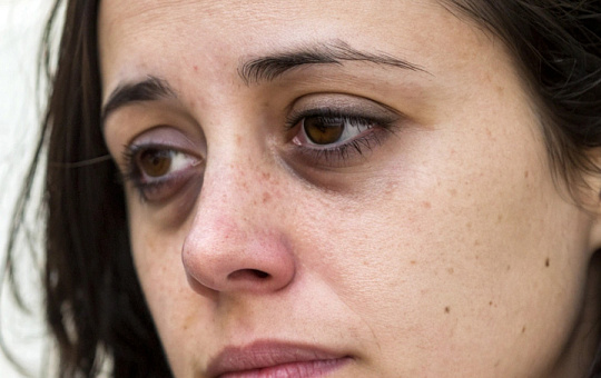 Стволовые клетки помогут против темных кругов под глазами