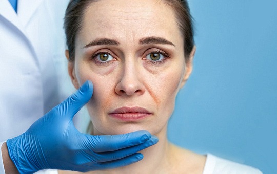 Кальция гидроксиапатит при изменениях кожи после резкого похудения