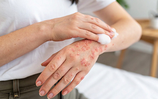 FDA одобрило пену Zoryve 0,3 % для лечения псориаза и себорейного дерматита