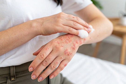 FDA одобрило пену Zoryve 0,3 % для лечения псориаза и себорейного дерматита