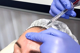 Контурная пластика лба филлерами: опыт пластического хирурга