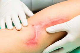 Актуальные вопросы лечения рубцов