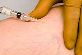 Эстетическая коррекция поверхностных вен нижних конечностей