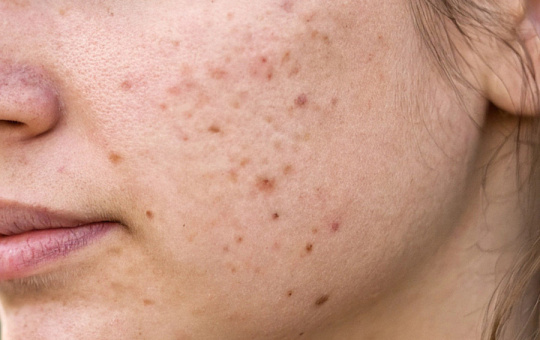 Поли-L-молочная кислота + фракционный лазер против рубцов постакне