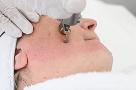 PIXEL CO₂: шлифовка без боли с минимальным периодом реабилитации и эффективно