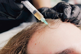 PRP-терапия + ортокремниевая кислота против андрогенной алопеции