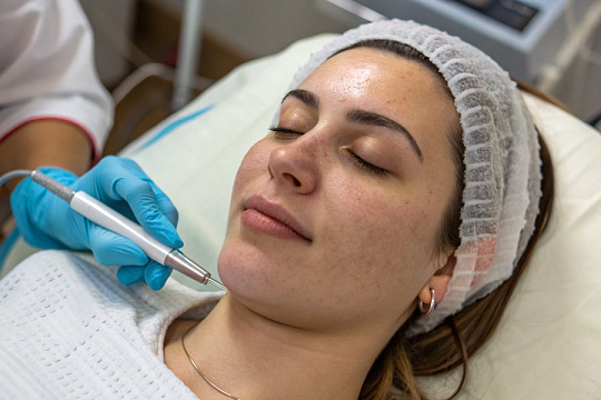 Радиочастотная коагуляция игольчатым электродом против гиперплазии сальных желез