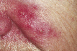 Розацеа в фокусе большой науки. Косметологи на плечах дерматологов