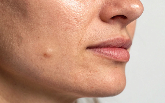 Биостимулирующие филлеры могут вызывать гранулемы инородного тела