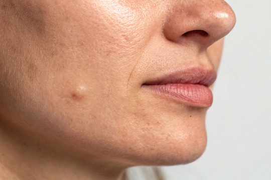 Биостимулирующие филлеры могут вызывать гранулемы инородного тела