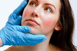 Применение лазера на красителе в терапии розацеа