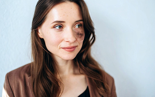 Невус Ота: классификация, лечение, клинические случаи