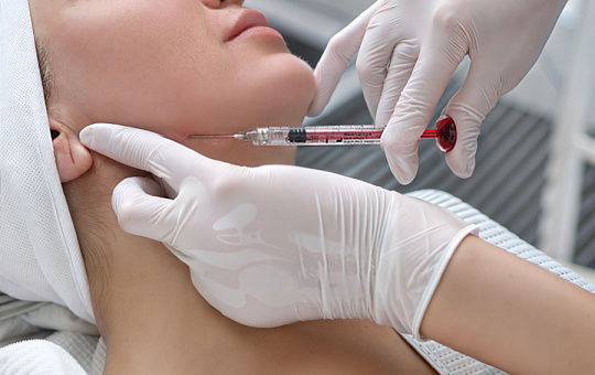 Двухэтапная коррекция нитями GT и восстановление объемов филлерами Neauvia