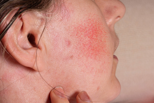 Пациенты: покраснение кожи наиболее раздражающий симптом розацеа