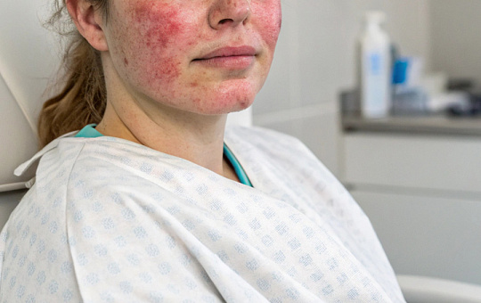 Между розацеа, гипертонией и дислипидемией нашли связь