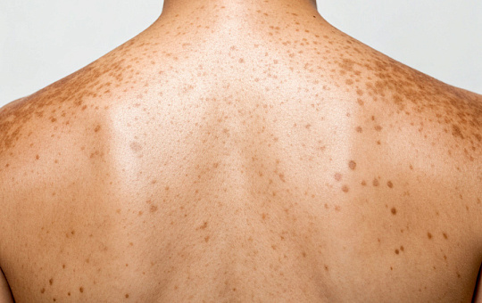 Оценить гиперпигментацию? Легко, когда есть шкалы