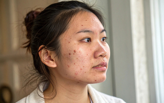 В Китае разработали новый алгоритм оценки тяжести акне