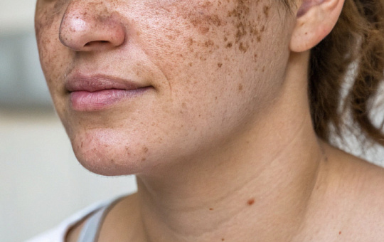 Комбинированное лечение при хлоазме эффективнее монотерапии