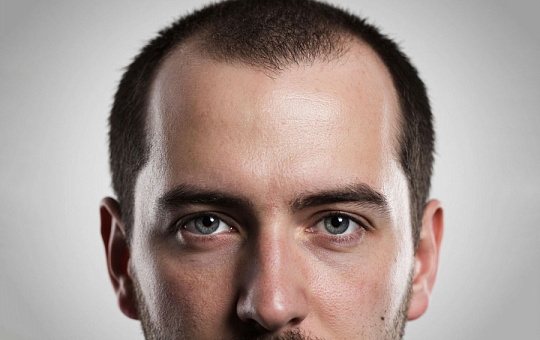 Дерматологи изучили баланс тиола у мужчин с алопецией