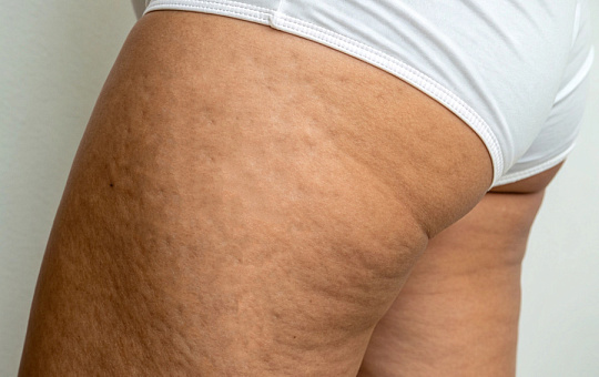 Исследование показало эффективность LPG-массажа против целлюлита