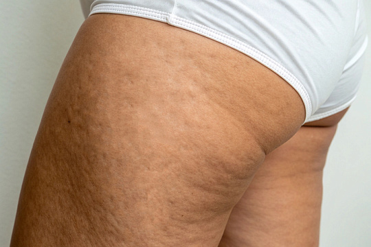 Исследование показало эффективность LPG-массажа против целлюлита