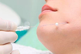 Нитевой лифтинг: мнение экспертов