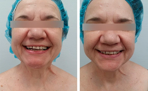 Ксеомин: фото до после