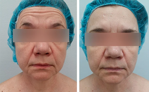 Ксеомин: фото до после