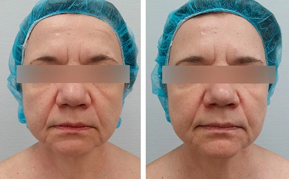 Ксеомин: фото до после