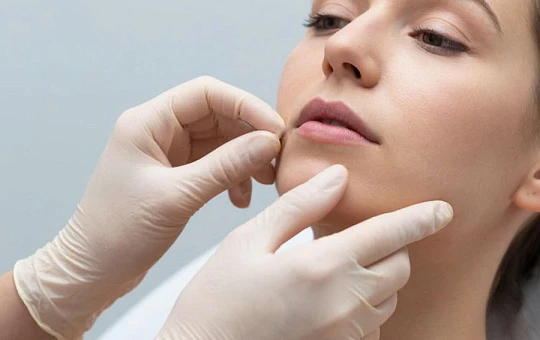 Restylane® Defyne теперь разрешены для коррекции подбородка