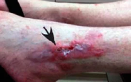Металлические имплантаты могут провоцировать рак кожи