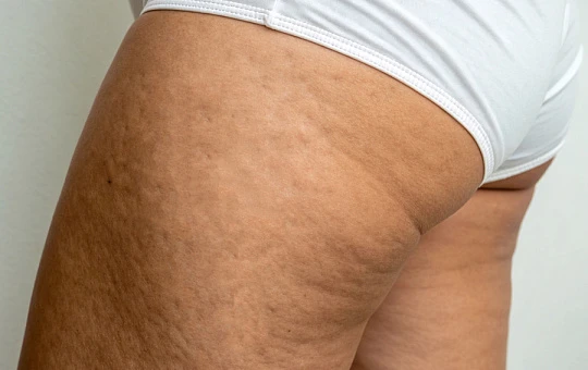 Исследование показало эффективность LPG-массажа против целлюлита