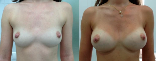 Увеличение груди (Доктор: Ф. Н. Мистакопуло)
