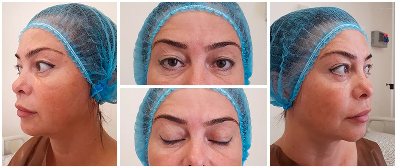 До псевдоблефаропластики на аппарате DEKA До псевдоблефаропластики на аппарате DEKA