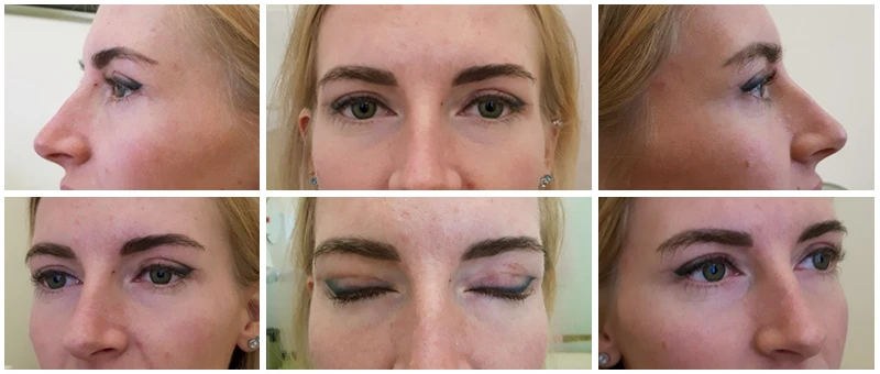 После псевдоблефаропластики на аппарате DEKA После псевдоблефаропластики на аппарате DEKA