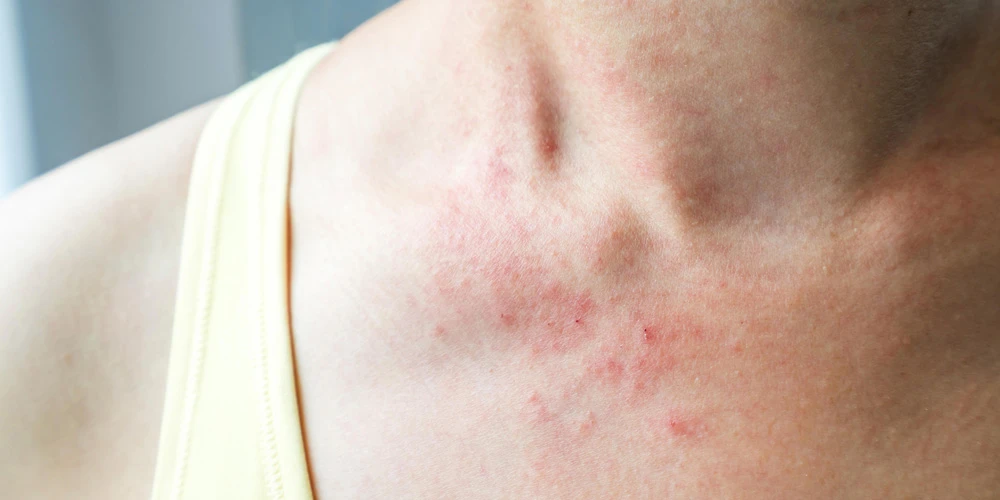 Митохондриальные заболевания с поражением кожи Митохондриальные заболевания с поражением кожи