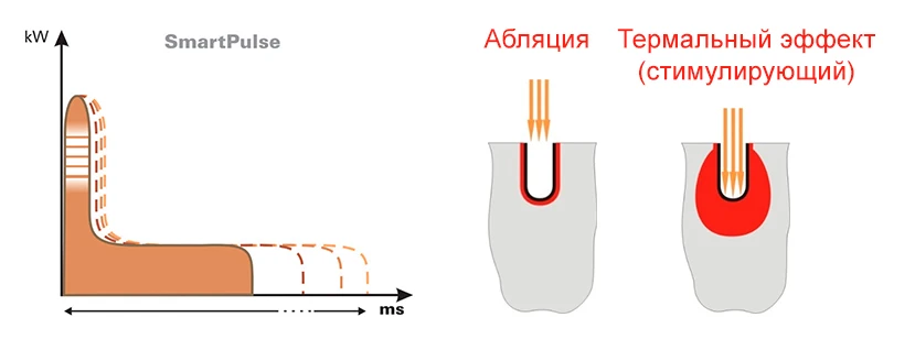 Форма импульса SmartPulse™ Форма импульса SmartPulse™