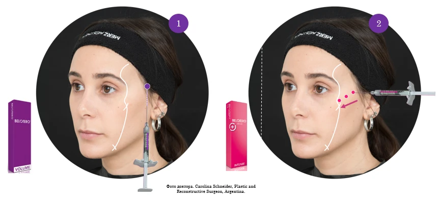 B.UP-Technik mit Belotero-Füllern