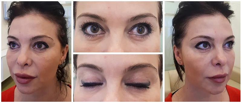 После псевдоблефаропластики на аппарате DEKA После псевдоблефаропластики на аппарате DEKA