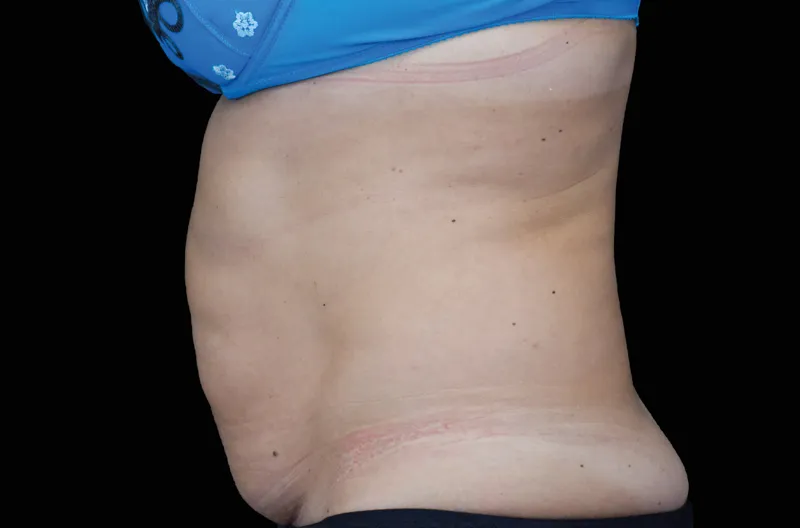 Фото до процедур на аппарате EMSCULPT