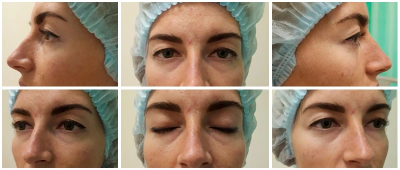 До псевдоблефаропластики на аппарате DEKA До псевдоблефаропластики на аппарате DEKA